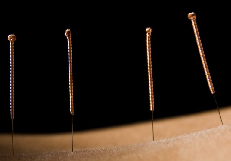 Acupuncture